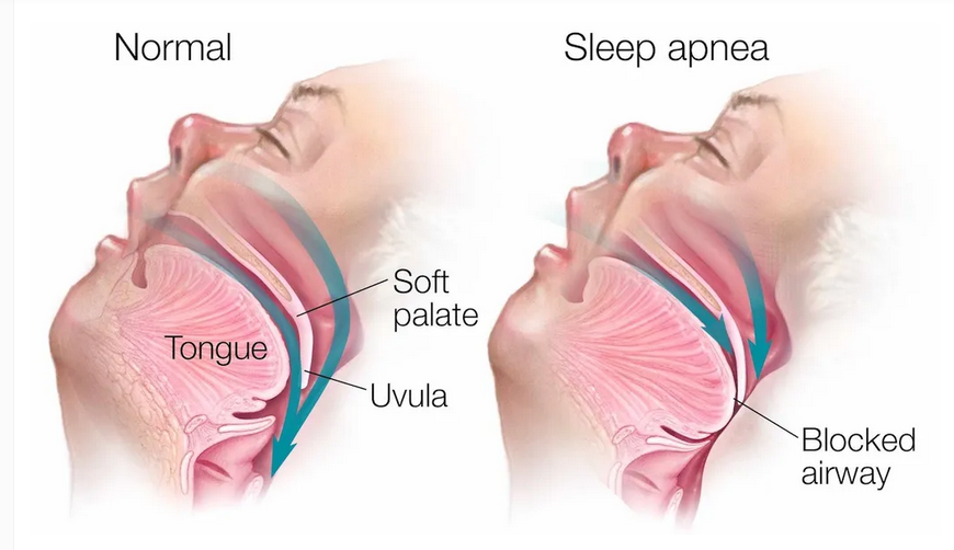 Does Sleep Apnea Affect Your Heart